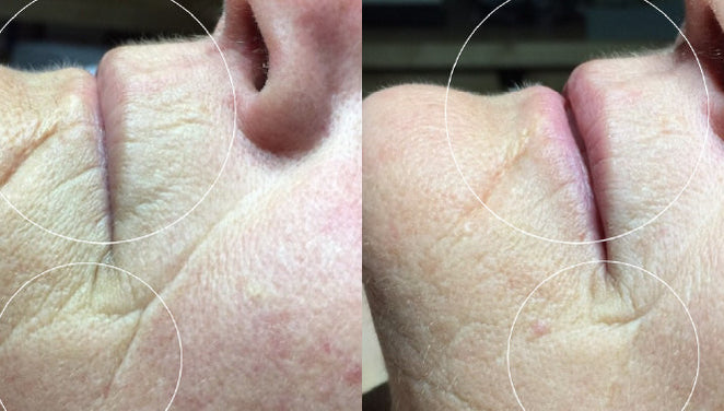 Before and after comparison of a person's nose with visible skin texture differences.