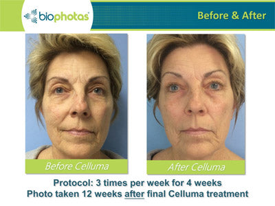 Red & LED Light Therapy before and after results photos