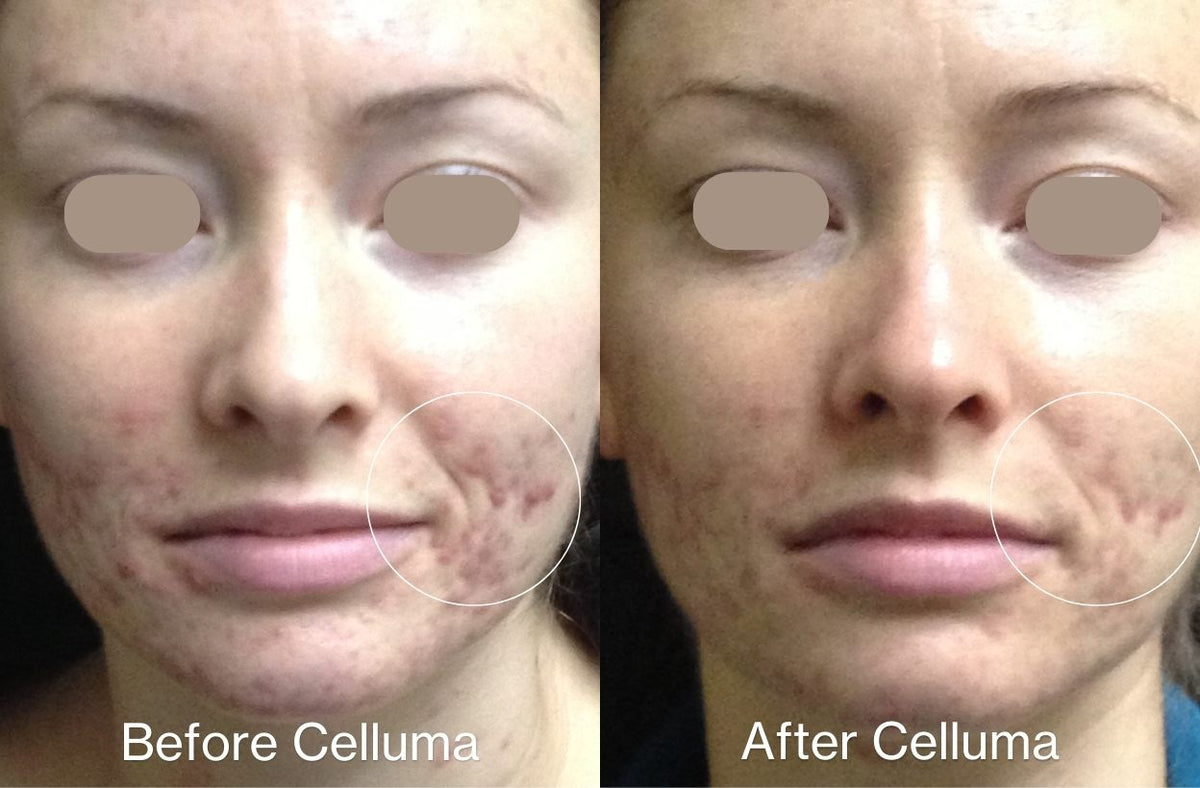Before Celluma (left) and After Celluma (right) showing a woman's face with reduced acne lesions and redness, and improvement in the overall appearance of the skin from red and blue LED light therapy. After photo was taken following 3 weeks of treatment 2 times per week for 30 minutes each session.