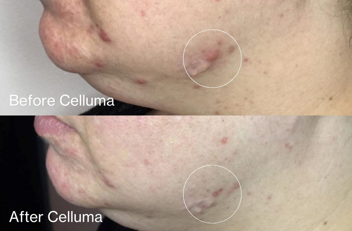 Before Celluma (top) and After Celluma (bottom) showing a woman with reduced acne lesions and redness using blue light therapy in combination with and red light. After photo was taken after 2 weeks with 4 total treatments.