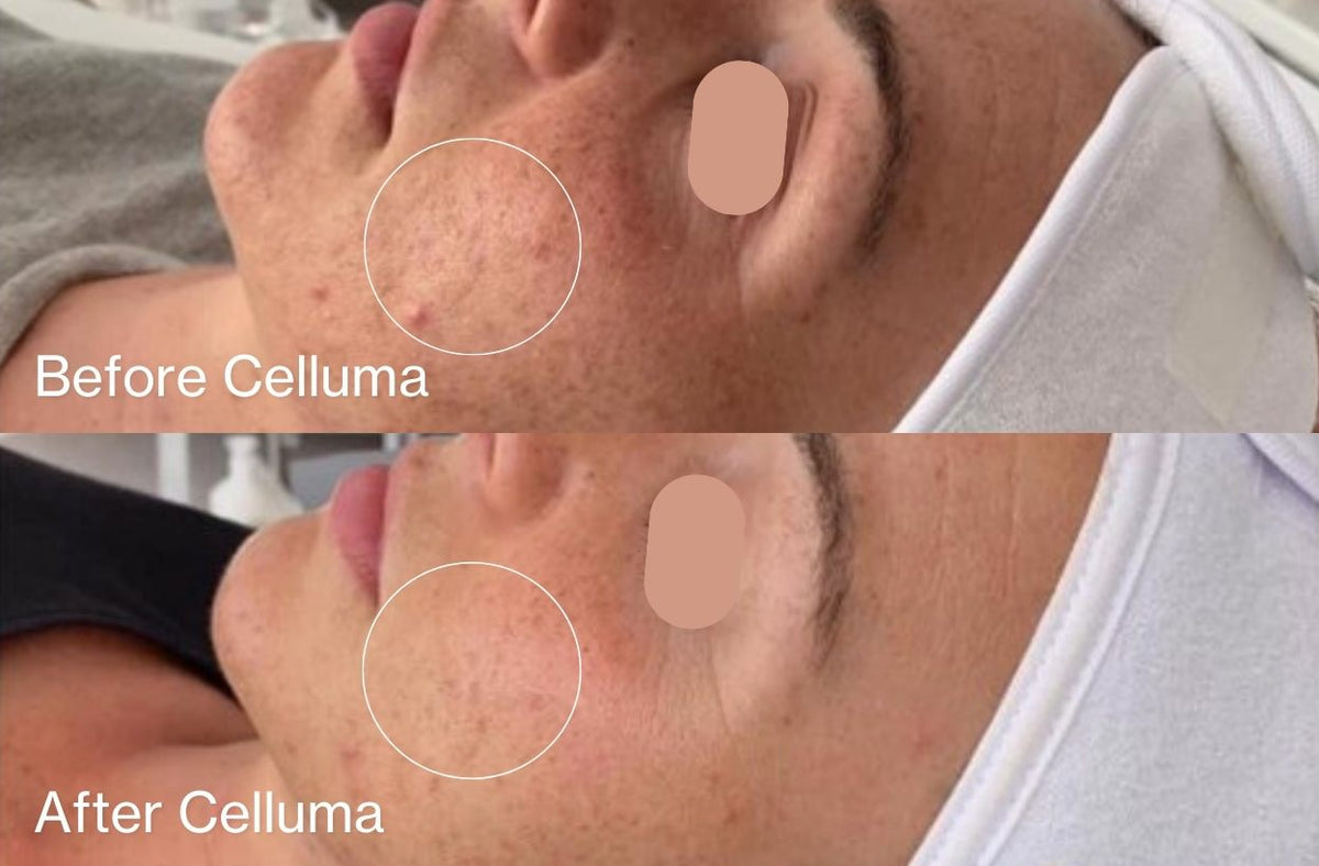 Before Celluma (top) and After Celluma (bottom) showing a woman's face with reduced acne lesions and improvement in the overall texture and appearance of the skin. After photo was taken following 4 total treatments over 2 weeks.