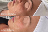Before Celluma (top) and After Celluma (bottom) showing a woman's face with reduced acne lesions and improvement in the overall texture and appearance of the skin. After photo was taken following 4 total treatments over 2 weeks.