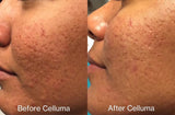 Before Celluma (left side) and After Celluma (right side) showing the side of a woman's face with reduced acne lesions and inflammation, and improvement in overall appearance of skin and scarring. Results after 8 weeks, using 2 times per week.
