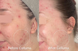 Before Celluma (left side) and After Celluma (right side) showing a woman with reduced acne blemishes and overall improvement of skin appearance. Results after 4 treatments.