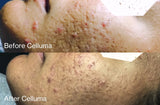 Before Celluma (top) and after Celluma (bottom) showing reduced acne lesions and the overall improvement in the texture and appearance of skin and scarring. Protocol 30 minutes, 2 times a week for 2 weeks. After photo is after 2 weeks.