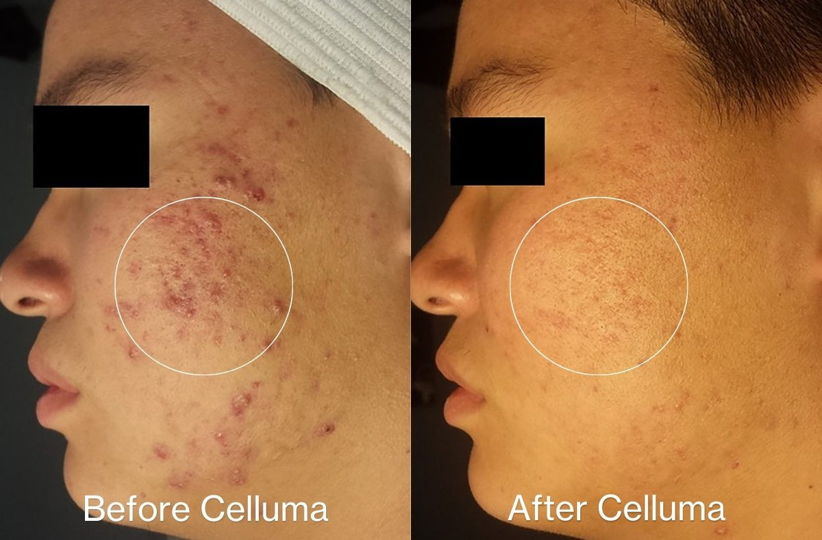 Before Celluma (left side) and After (right side) showing acne patient showing significantly reduced acne lesions and redness with red and blue LED light therapy. After photo was taken following 8 weeks of treatment 2 times per week.