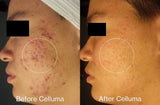 Before Celluma (left side) and After (right side) showing acne patient showing significantly reduced acne lesions and redness with red and blue LED light therapy. After photo was taken following 8 weeks of treatment 2 times per week.