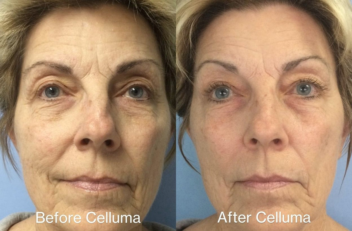 Before and after images of a women's face showing her appearance after using LED red light therapy.