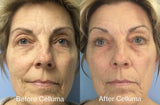 Before and after images of a women's face showing her appearance after using LED red light therapy (mobile version).