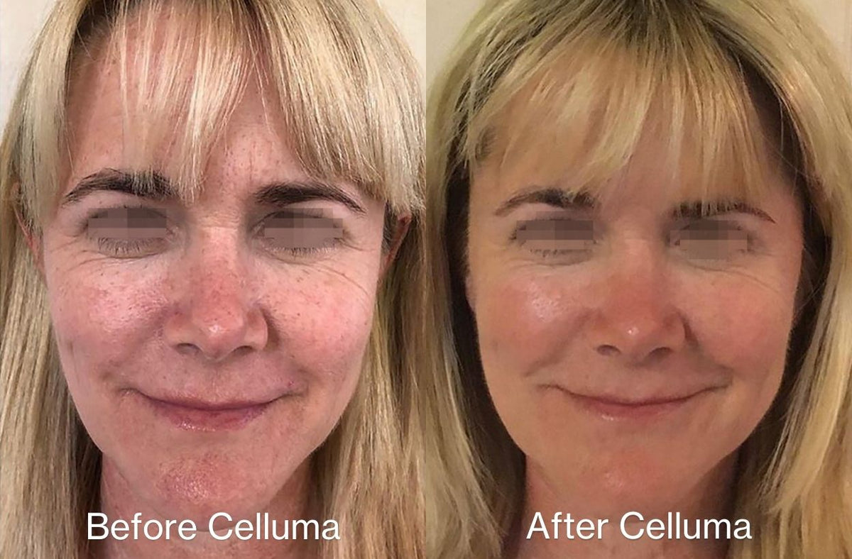 Before (left) and after image (right) of a women's face showing wrinkle reduction and improvement in the skin's overall texture and appearance with the use of red light therapy. After photo taken following 10 weeks of treatments with 1 treatment per week.