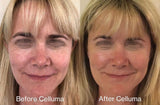 Before (left) and after image (right) of a women's face showing wrinkle reduction and improvement in the skin's overall texture and appearance with the use of red light therapy. After photo taken following 10 weeks of treatments with 1 treatment per week.