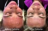 Before Celluma (left) and after Celluma (right) depicting a woman's face following 1 treatment with LED light therapy after microneedling. After results show a reduction in redness and overall improvement in the texture and appearance of the skin.