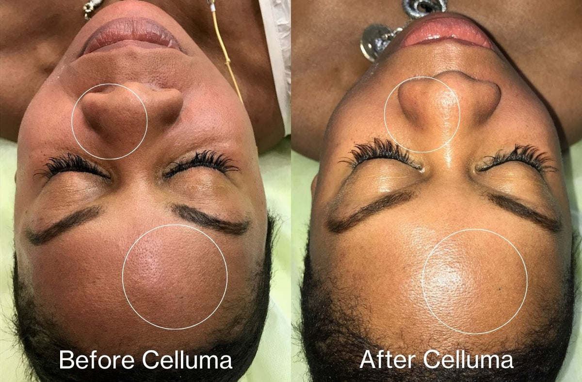 Before (left) and after (right) showing a woman's face and forehead who had a single treatment of Celluma red light therapy following a microneedling treatment to the skin. Results showing reduced redness and inflammation.