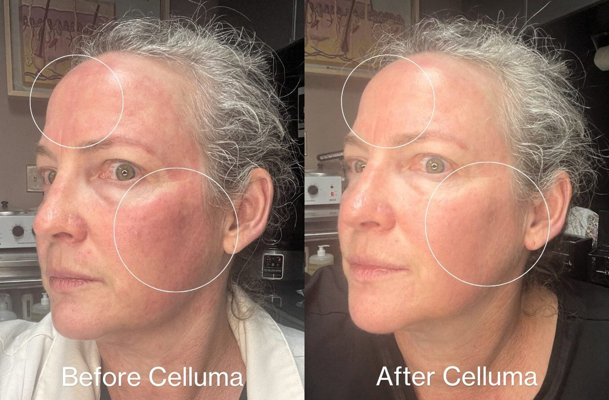 Red light therapy before and after images showing reduced redness on a woman's face