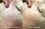 Before and after pictures showing effects of red light therapy to treat wrinkles (mobile version).
