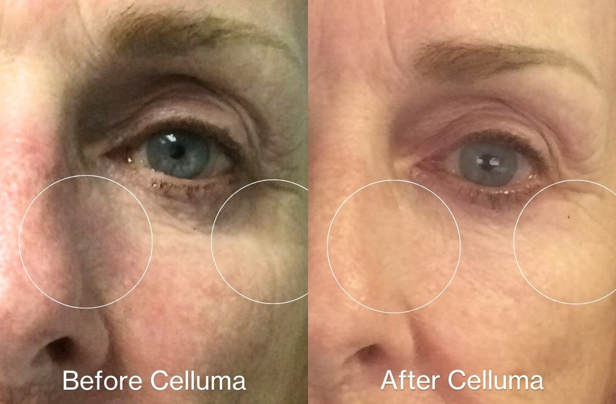 LED red light therapy before and after images showing reduced fine lines and wrinkles around the eyes