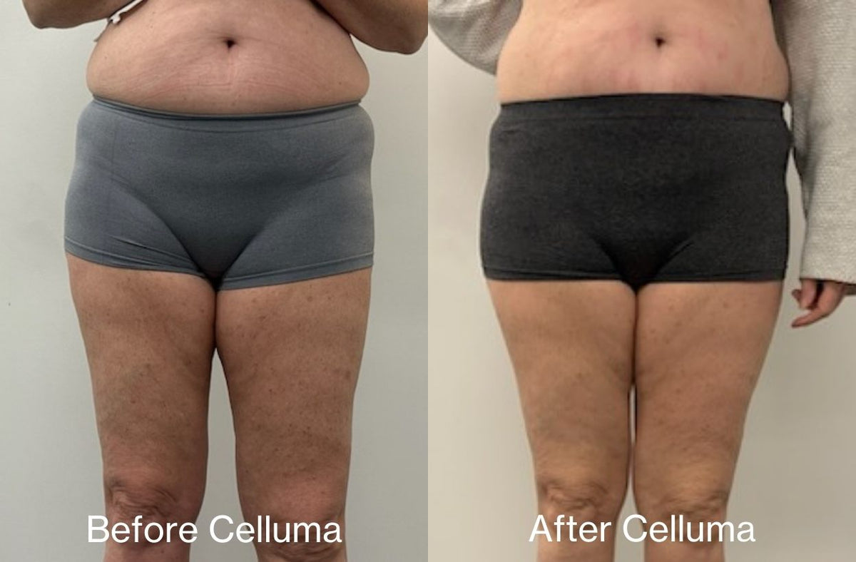 Red light therapy before and after photos showing body contouring results