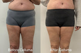 Red light therapy before and after photos showing body contouring results (mobile version)