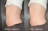 Red light therapy before and after photos showing results of body contouring reducing fat around the belly (mobile version)