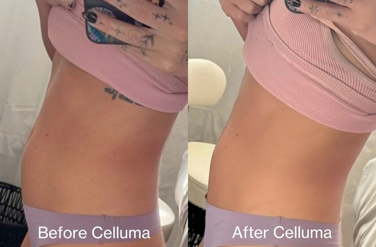 Red light therapy before and after photos showing results of body contouring on the stomach