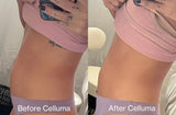Red light therapy before and after photos showing results of body contouring on the stomach (mobile version)