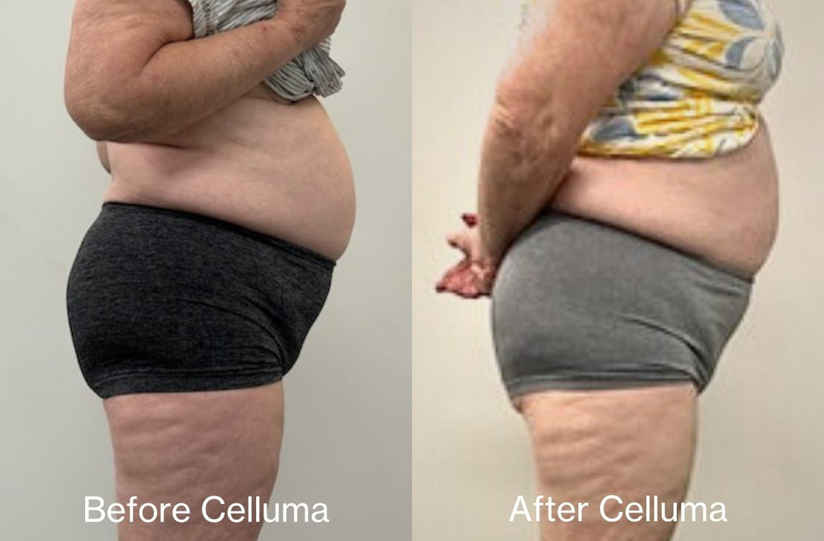 LED red light therapy before and after photos showing body contouring results on reducing belly fat