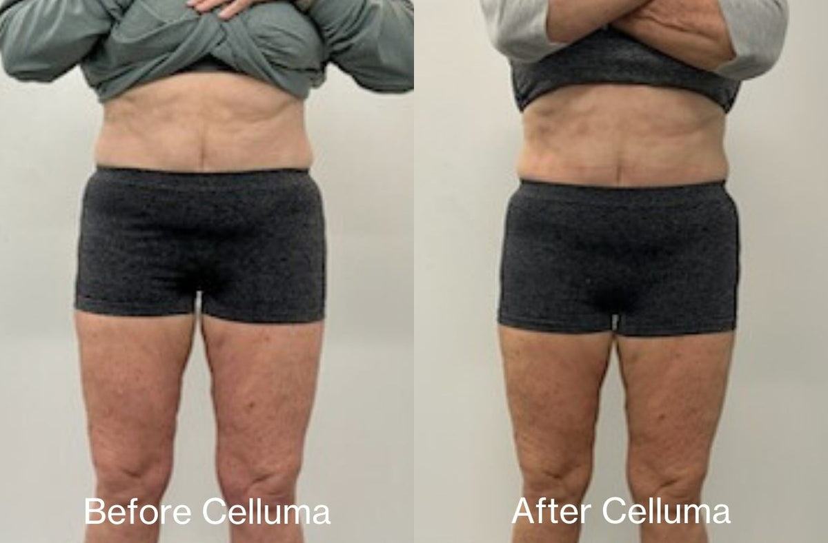 Front view of LED red light therapy before and after photos showing results of body contouring reducing fat around the mid-section