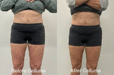 Front view of LED red light therapy before and after photos showing results of body contouring reducing fat around the mid-section (mobile version)