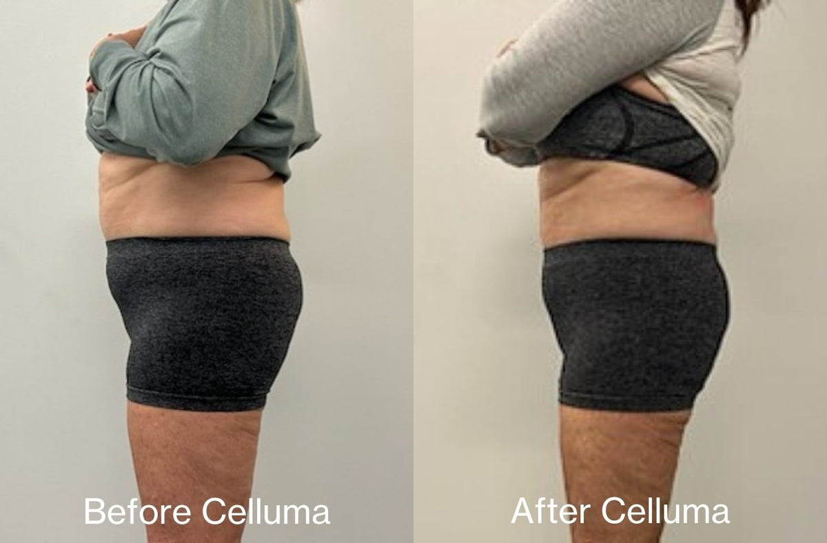 Red light therapy before and after photos showing results of body contouring reducing fat around the mid-section