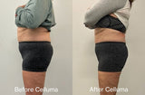 Red light therapy before and after photos showing results of body contouring reducing fat around the mid-section (mobile version)