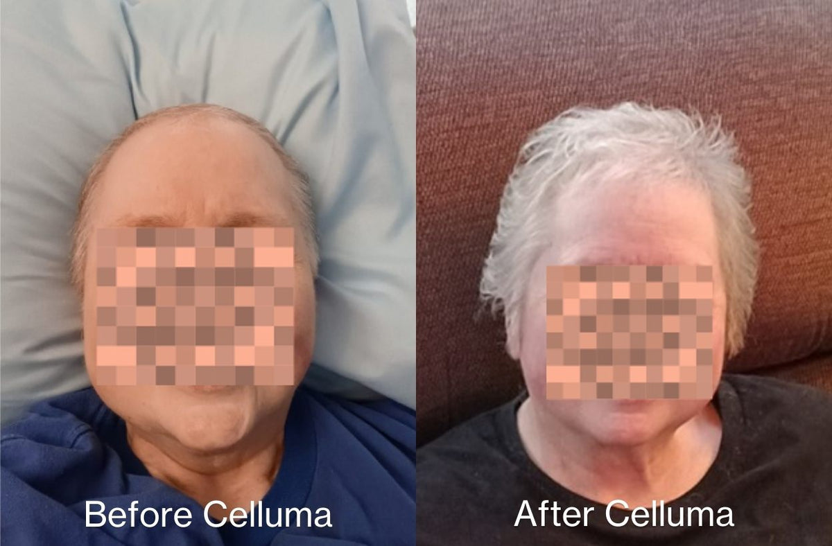 Before image (left) and after image (right) of a 69-year old woman showing a thicker head of hair and increased hair growth following treatment with LED red light therapy. Treatment was with the Celluma RESTORE over 5 months. No other modalities used.