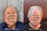 Before image (left) and after image (right) of a 69-year old woman showing a thicker head of hair and increased hair growth following treatment with LED red light therapy. Treatment was with the Celluma RESTORE over 5 months. No other modalities used.