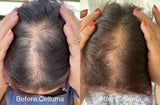 Before and after images of a woman parting the hair on her head showing increased hair growth using red light therapy for 16 weeks every other day. Before Celluma (left), After Celluma (right). Device used was the Celluma RESTORE.