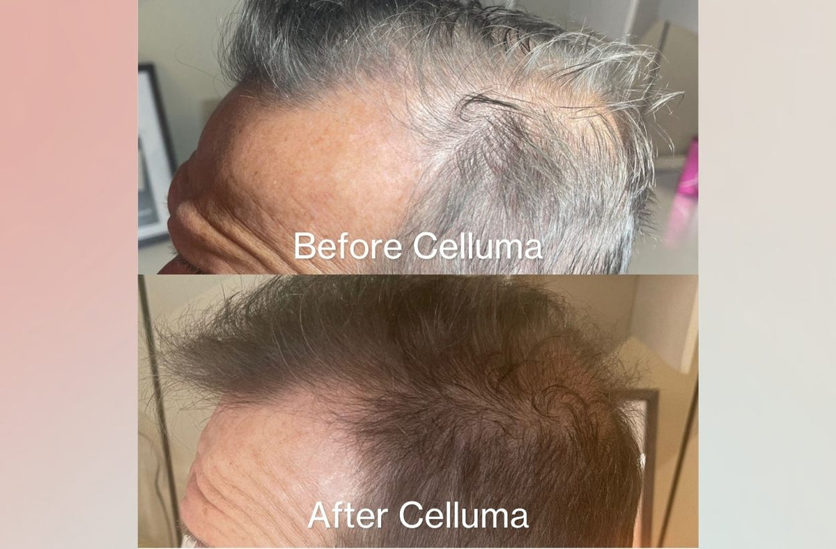 Before and After (top and bottom) showing a the side of a man's head with darker hair and new hair growth on the scalp after LED red light therapy treatments. Results after 12 weeks.