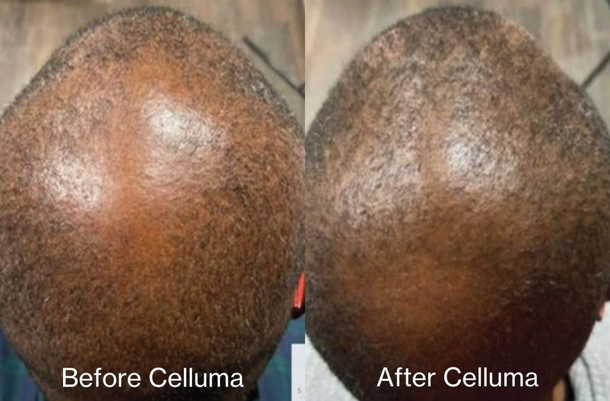 Before and after results of a 60-year old male showing new follicle and hair growth on the top of the scalp following 4 months of treatment with LED red light therapy. Before image taken 11/10/2021. After image taken 3/9/2022.