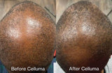 Before and after results of a 60-year old male showing new follicle and hair growth on the top of the scalp following 4 months of treatment with LED red light therapy. Before image taken 11/10/2021. After image taken 3/9/2022.