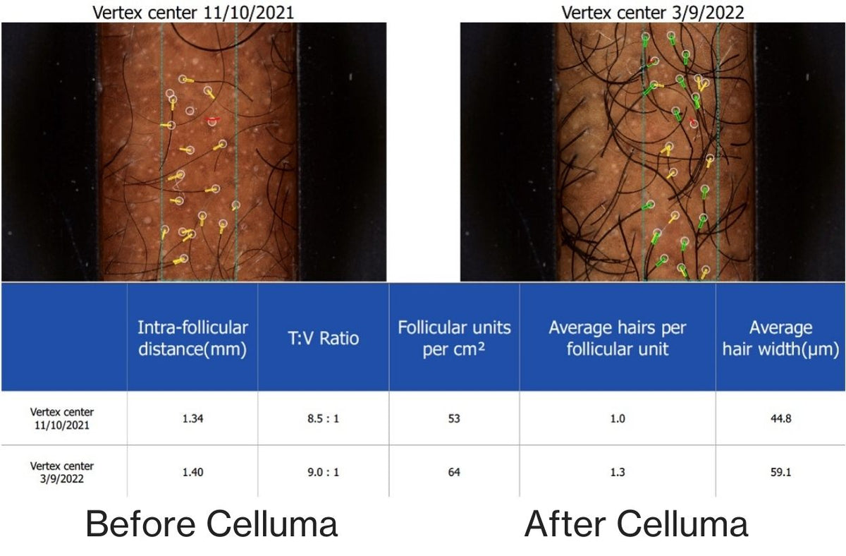 Before and after results of a 60-year old male showing microscopic view of new follicle and hair growth on the top of the scalp following 4 months of treatment with LED red light therapy. Before image taken 11/10/2021. After image taken 3/9/2022.