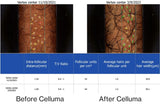 Before and after results of a 60-year old male showing microscopic view of new follicle and hair growth on the top of the scalp following 4 months of treatment with LED red light therapy. Before image taken 11/10/2021. After image taken 3/9/2022.