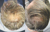 Before and after results of a 47-year old male showing new follicle and hair growth on the top of the scalp following 4 months of treatment with LED red light therapy. Before image taken 11/8/2021; after image taken 3/8/2022.