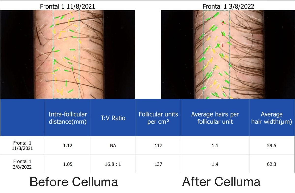 Before and after results of a 47-year old male showing a microscopic view of new follicle and hair growth on the scalp following 4 months of treatment with the Celluma RESTORE red light therapy device for hair growth. Before image taken 11/8/2021; after image taken 3/8/2022.