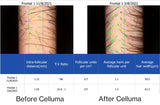 Before and after results of a 47-year old male showing a microscopic view of new follicle and hair growth on the scalp following 4 months of treatment with the Celluma RESTORE red light therapy device for hair growth. Before image taken 11/8/2021; after image taken 3/8/2022.