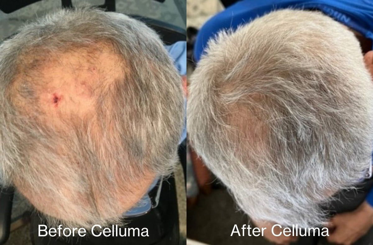 Before Celluma (left) and after Celluma (right) showing the top of a man's head with significant new hair growth following 16 weeks of LED red light therapy treatments every other day.