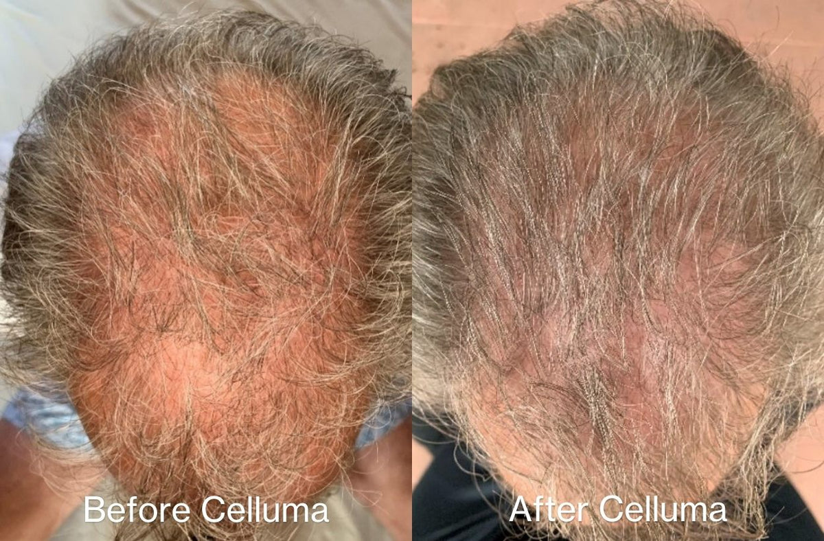 Before and after images showing the top of the head of a man in his 60's with increased hair growth following Celluma red light therapy treatment. After photo taken following 16 weeks of treatment, every other day for 30 minutes.