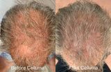 Before and after images showing the top of the head of a man in his 60's with increased hair growth following Celluma red light therapy treatment. After photo taken following 16 weeks of treatment, every other day for 30 minutes.