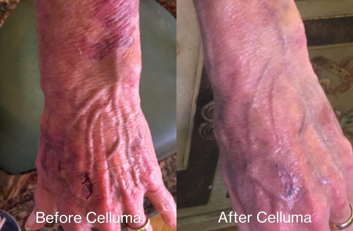 Before and after images of a man's hand showing reduced bruising and redness following 9 days of LED red light therapy treatment.