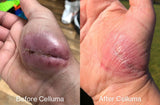 Before and after results of a woman's hand post-surgery following the treatment of red and near-infrared light therapy for pain. Results show reduced redness, inflammation, and accelerated wound healing.