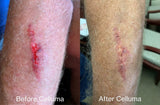Before and after results of a man who used red light and near-infrared light therapy on his leg after a fall with the Celluma PRO on pain mode.