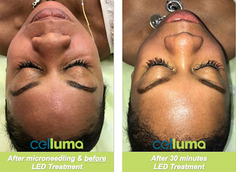 Woman before and after Celluma Led Treatment