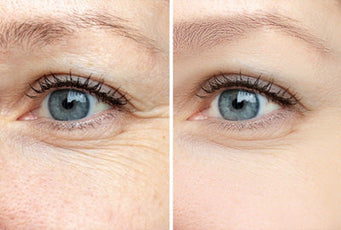 Before and After Eye Wrinkle Treatment