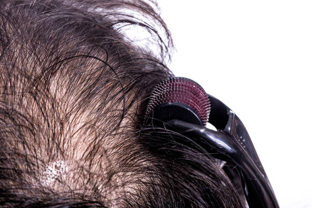 Close-up image of a scalp about to receive microneedling and red light therapy treatment